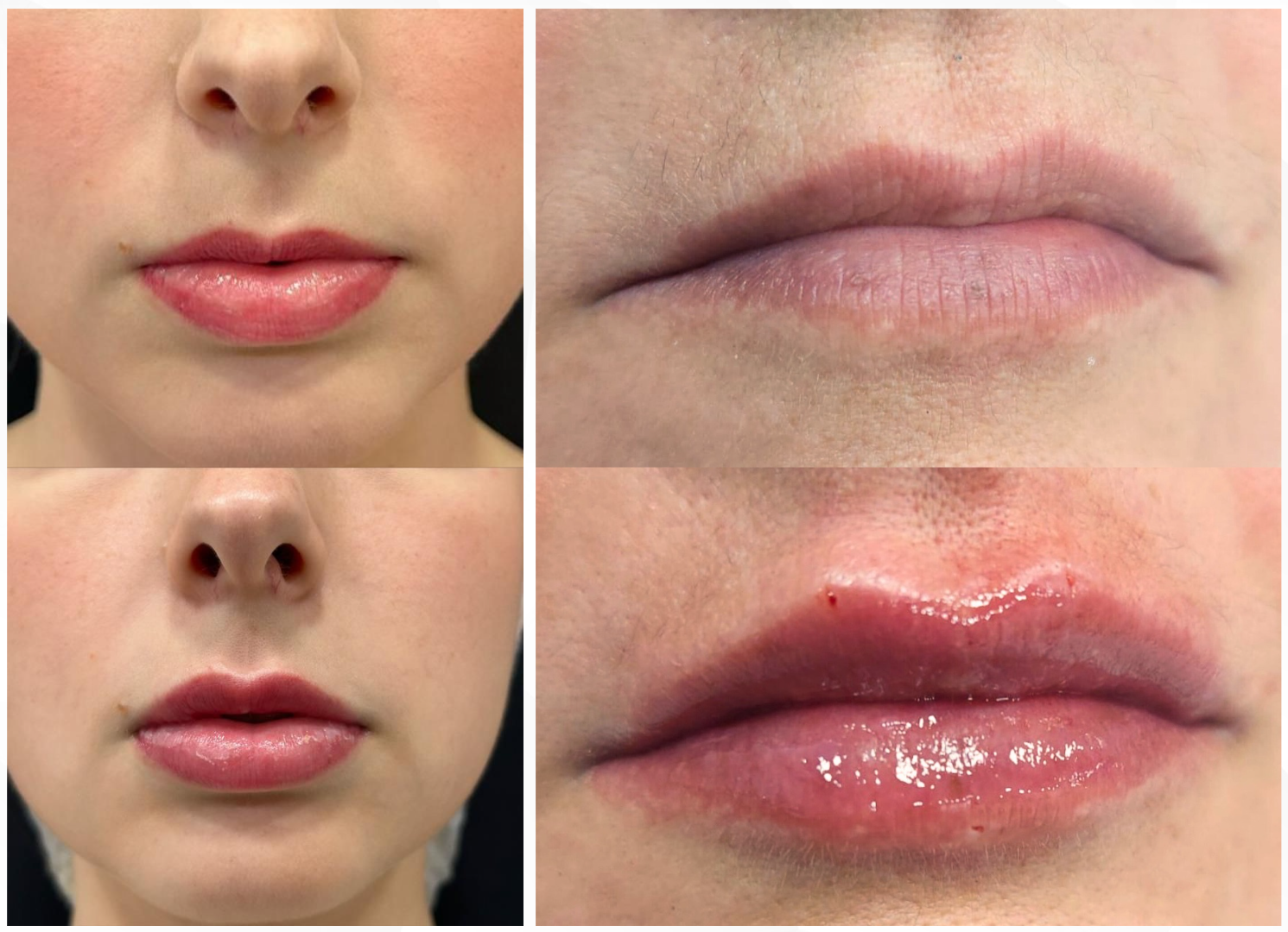 Preenchimento Labial 2