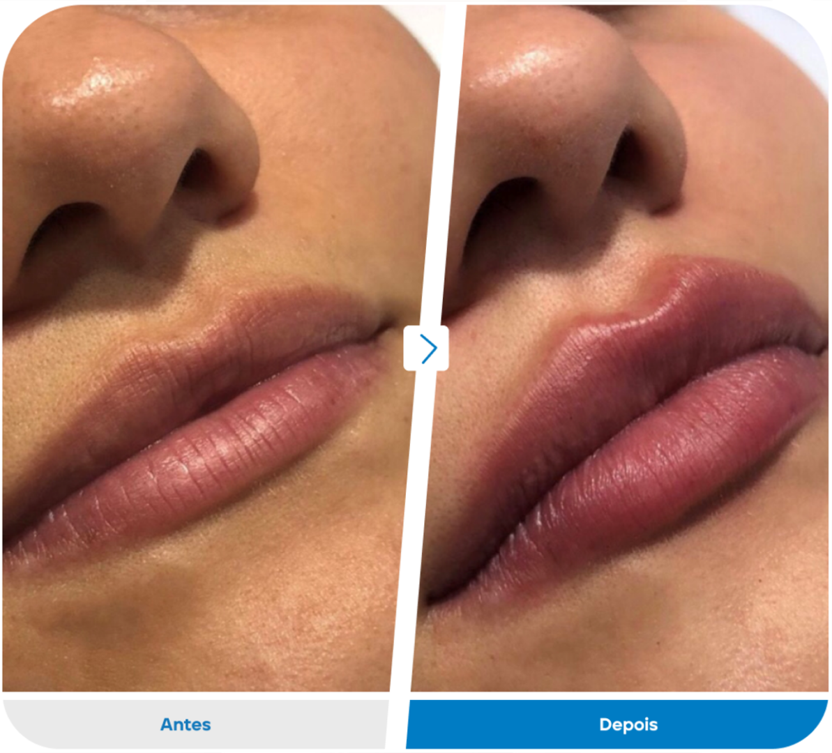 Preenchimento Labial1