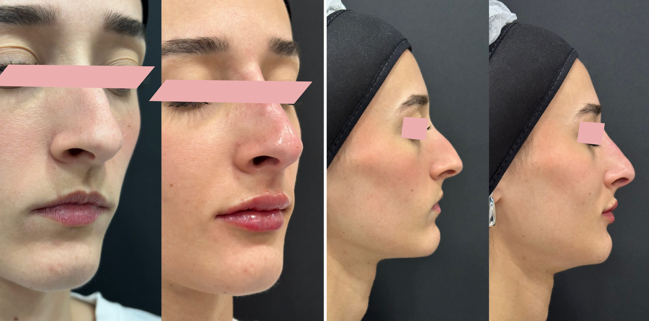 Harmonizacao-Facial-1