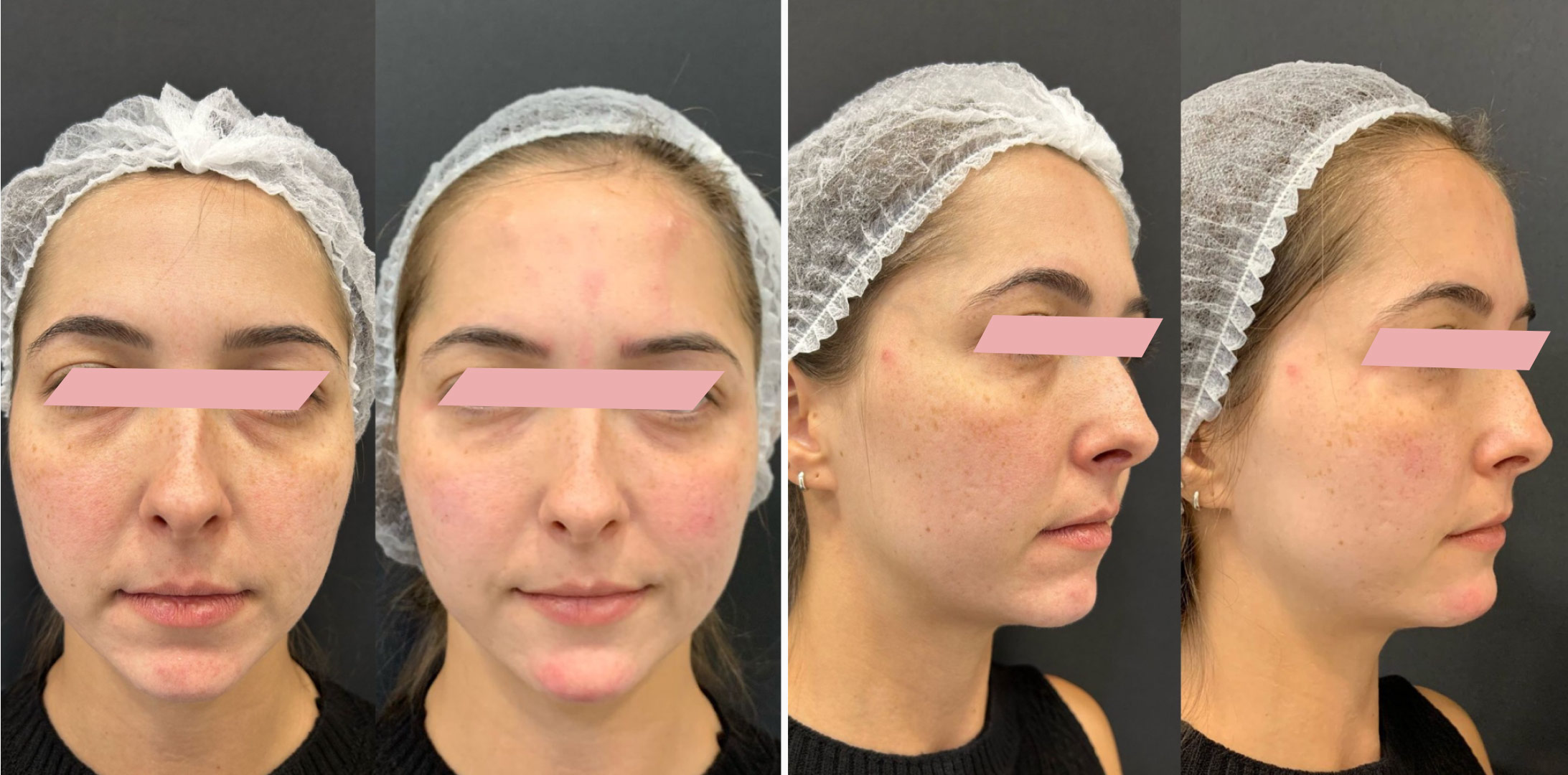 Harmonizacao-Facial-2