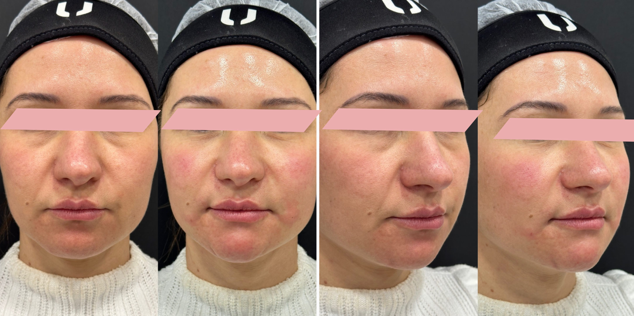 Harmonizacao-Facial-3