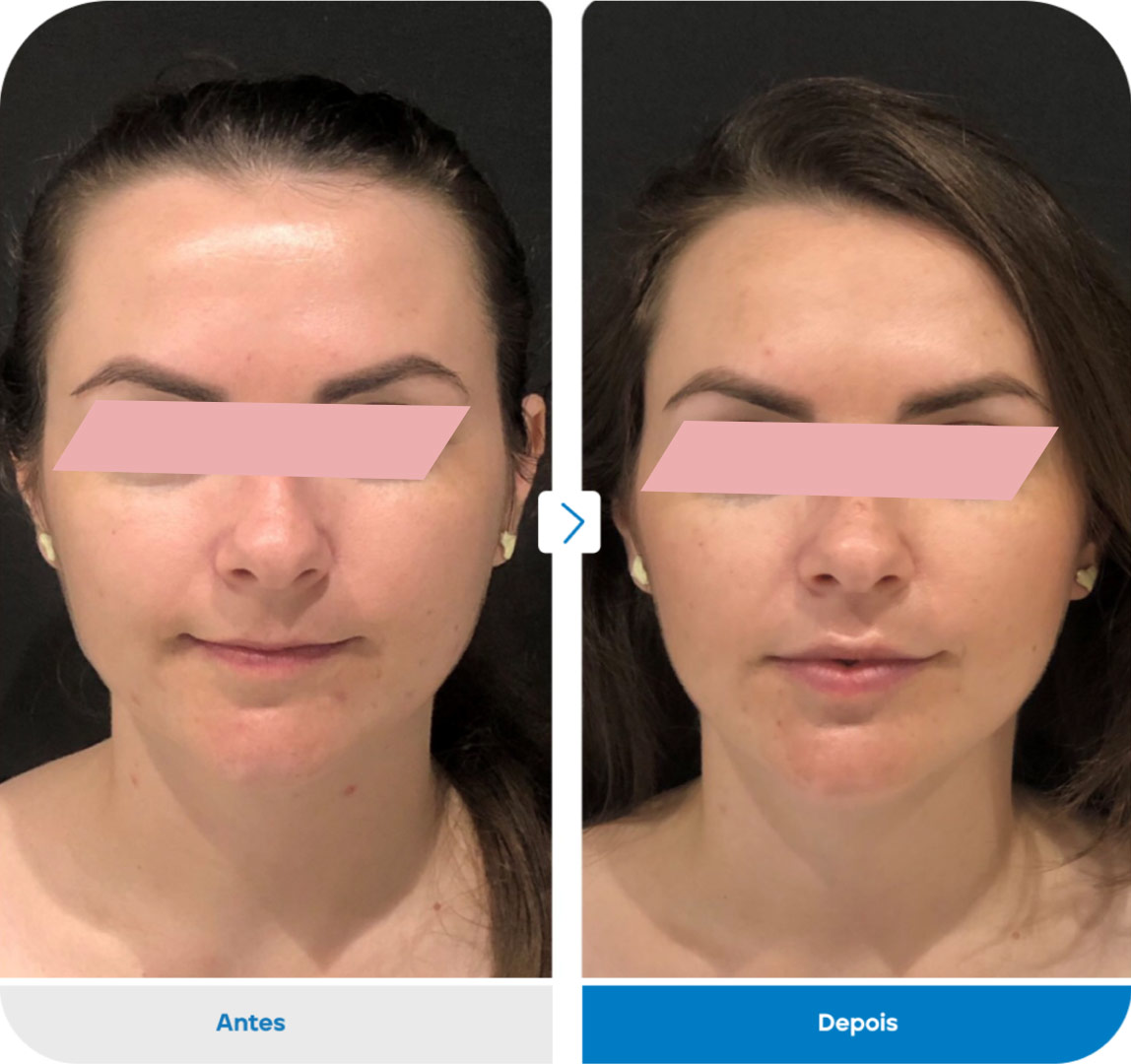 Preenchimento-Labial1-1