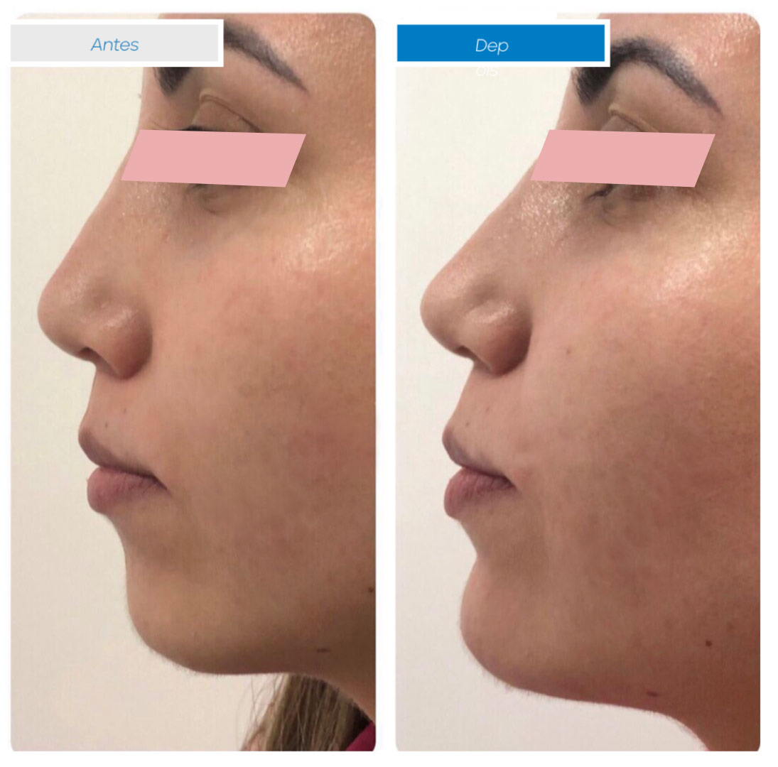 Preenchimento-de-Mento