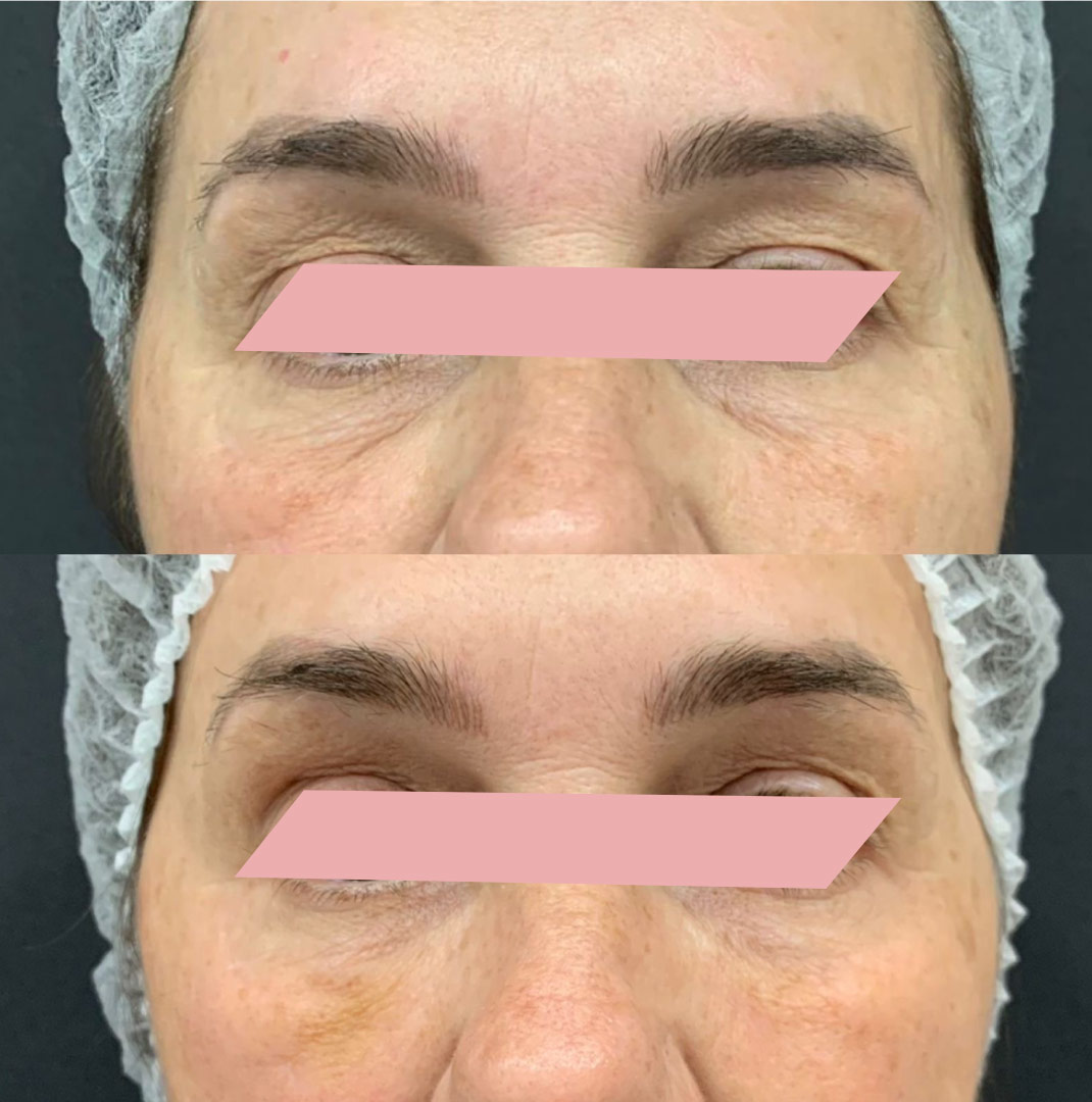 Preenchimento-de-Olheiras-1