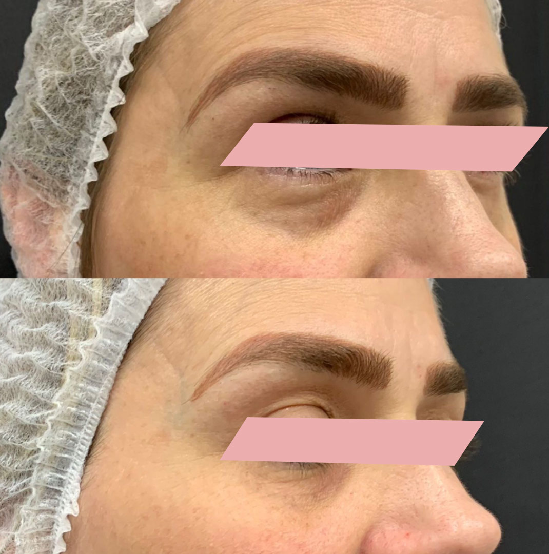 Preenchimento-de-Olheiras-2