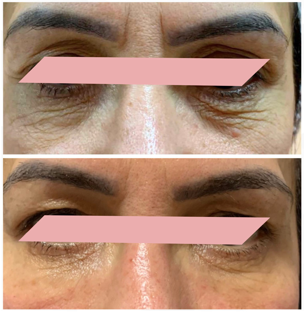 Preenchimento-de-Olheiras-3