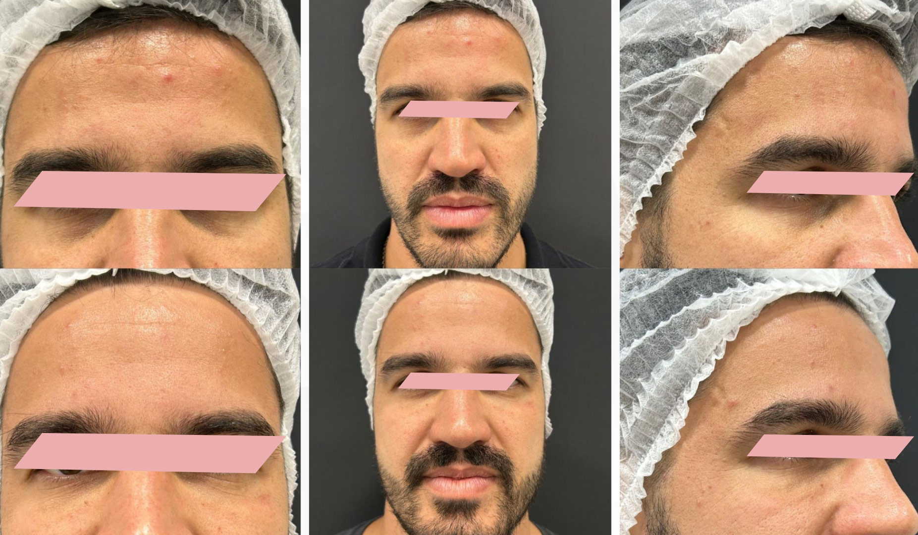 Preenchimento-de-Olheiras-4